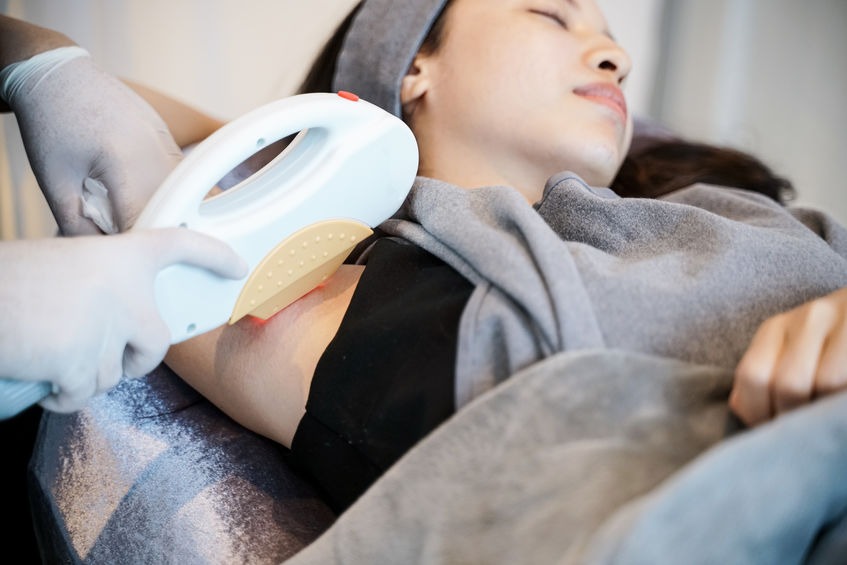 épilation laser